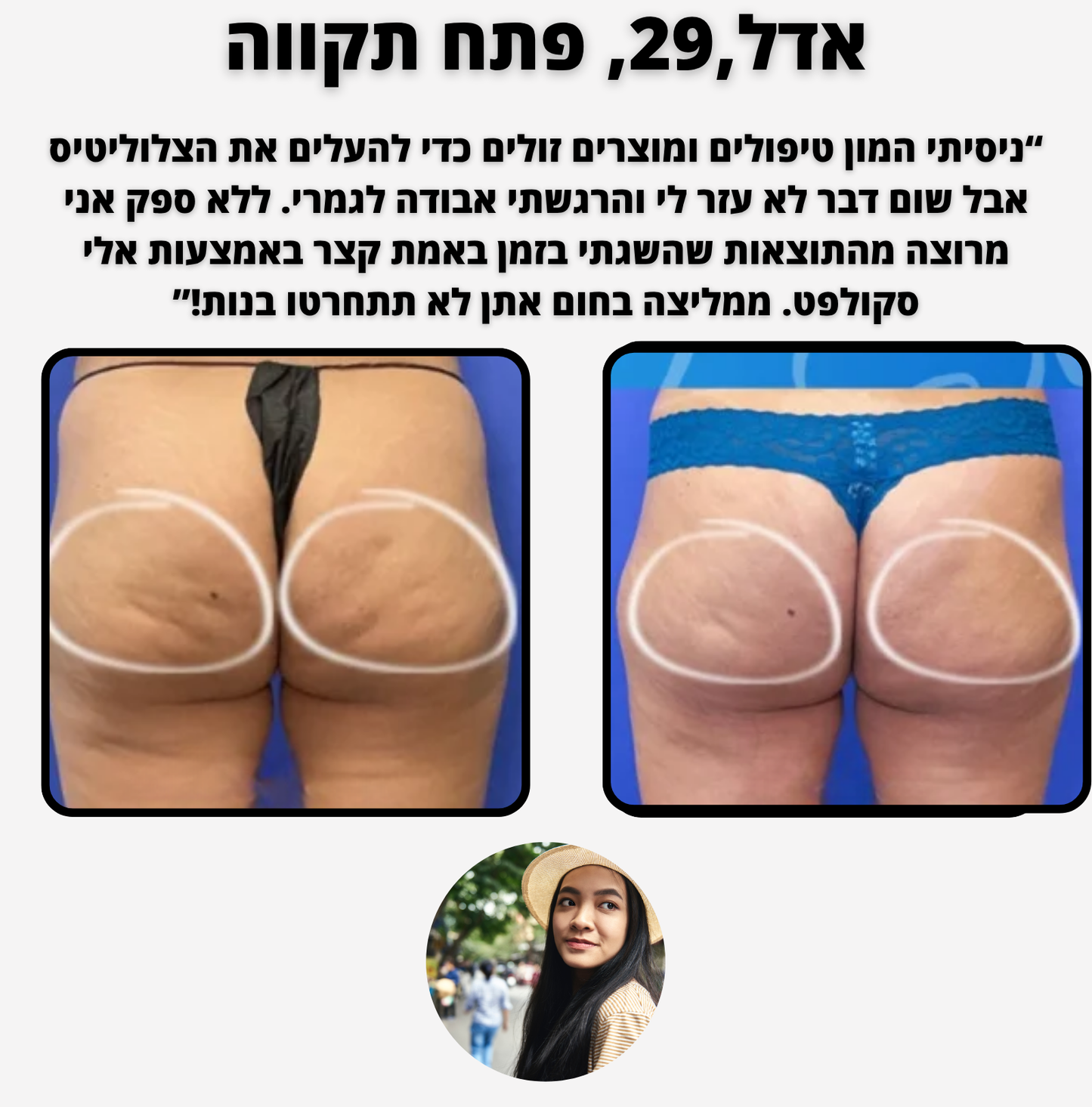 ELI SCULPT - צלוליטיס ומיצוק העור